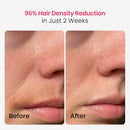 SALLOOT TRIPLE-PULSE IPL LASER HAIR REMOVAL 12CM² SAPPHIRE 37°F DT015 - NAVY - Like New