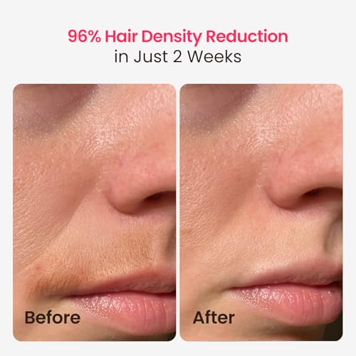 SALLOOT TRIPLE-PULSE IPL LASER HAIR REMOVAL 12CM² SAPPHIRE 37°F DT015 - NAVY - Like New